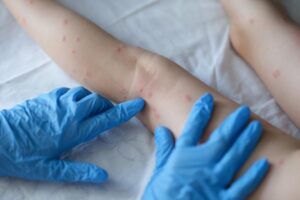 Read more about the article Ministro diz que Brasil terá antiviral para tratar varíola dos macacos