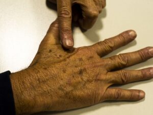 Read more about the article Dezembro Laranja: Câncer de pele é o mais comum no Brasil; saiba como evitar
